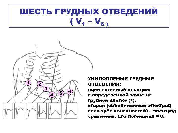 Наложение электродов экг картинки