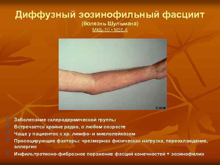 Диффузный эозинофильный фасциит (болезнь Шульмана) МКБ-10 • M 35. 4 ü ü ü Заболевание