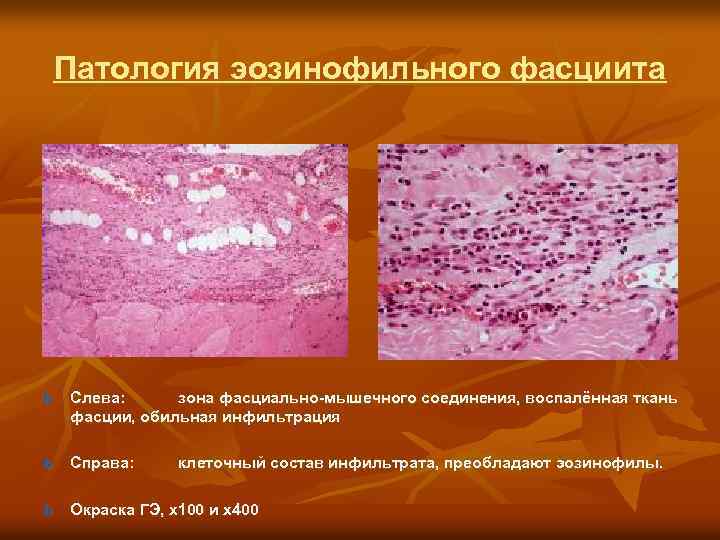 Патология эозинофильного фасциита ь Слева: зона фасциально-мышечного соединения, воспалённая ткань фасции, обильная инфильтрация ь