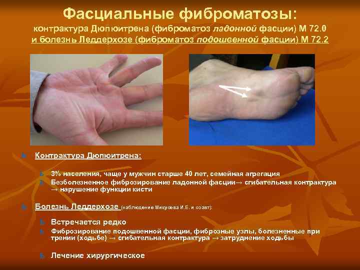 Фасциальные фиброматозы: контрактура Дюпюитрена (фиброматоз ладонной фасции) М 72. 0 и болезнь Леддерхозе (фиброматоз