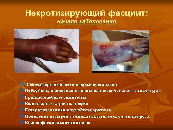 Некротизирующий фасциит: начало заболевания v. Дискомфорт в области повреждения кожи v. Отёк, боль, покраснение,