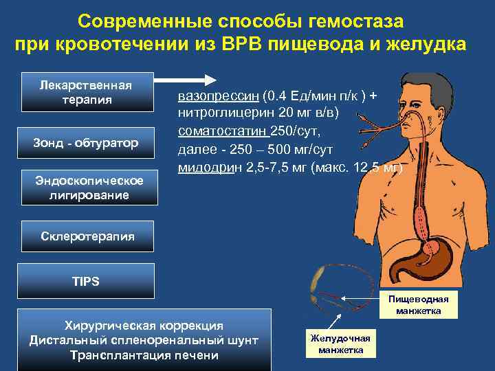 Современные способы гемостаза при кровотечении из ВРВ пищевода и желудка Лекарственная терапия Зонд -