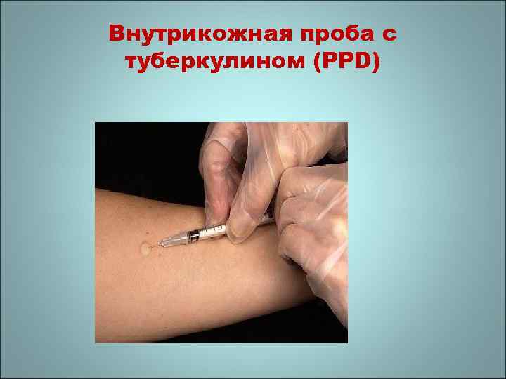 Внутрикожная проба с туберкулином (PPD) 