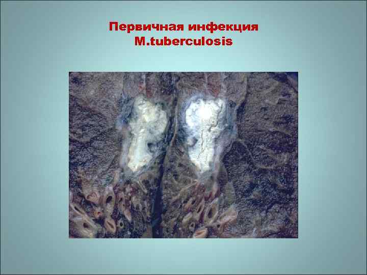 Первичная инфекция M. tuberculosis 