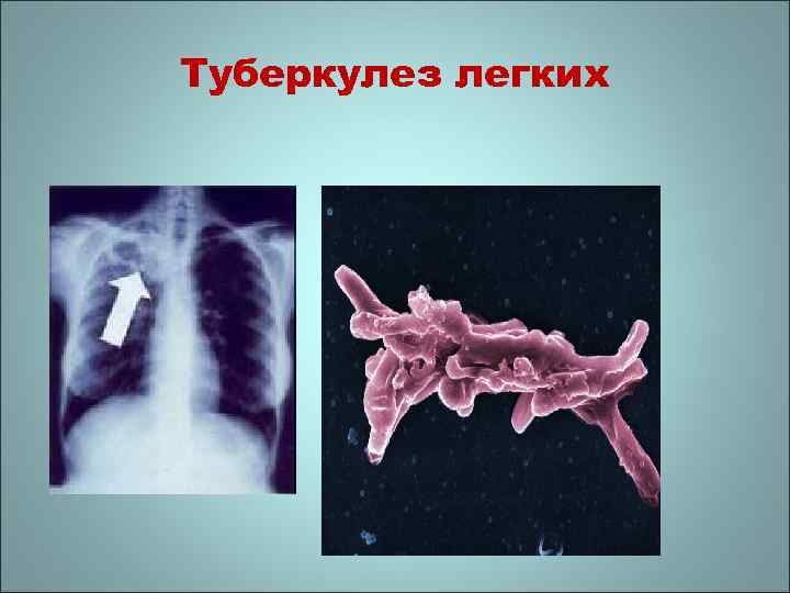 Микобактерии туберкулеза в мокроте фото