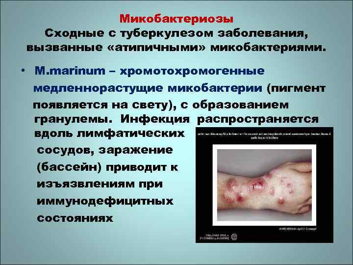 Микобактериозы Сходные с туберкулезом заболевания, вызванные «атипичными» микобактериями. • M. marinum – хромотохромогенные медленнорастущие