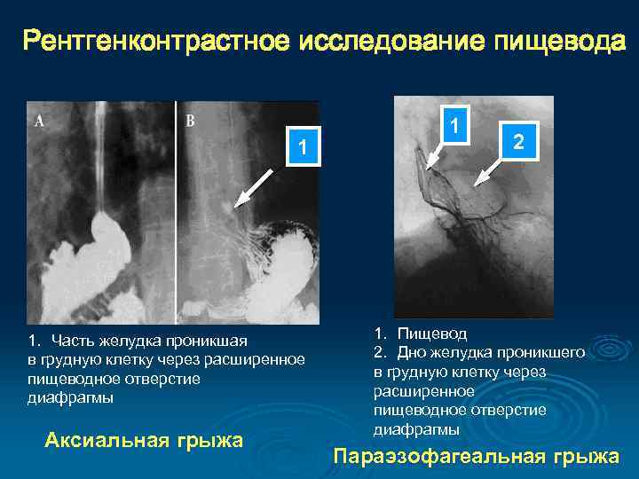 Рентгенконтрастное исследование пищевода 1 1. Часть желудка проникшая в грудную клетку через расширенное пищеводное
