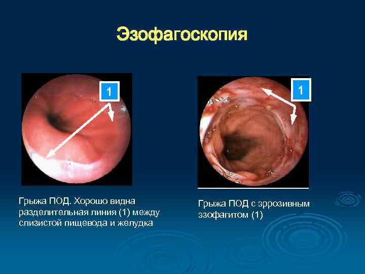 Эзофагоскопия 1 Грыжа ПОД. Хорошо видна разделительная линия (1) между слизистой пищевода и желудка