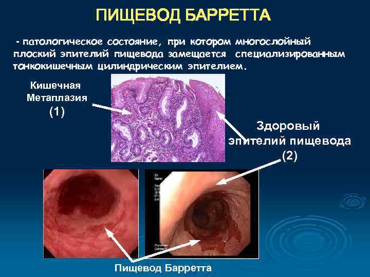 ПИЩЕВОД БАРРЕТТА - патологическое состояние, при котором многослойный плоский эпителий пищевода замещается специализированным тонкокишечным