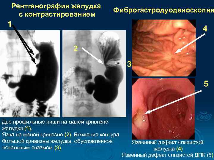 Рентгенография желудка с контрастированием Фиброгастродуоденоскопия 1 4 2 3 5 Две профильные ниши на