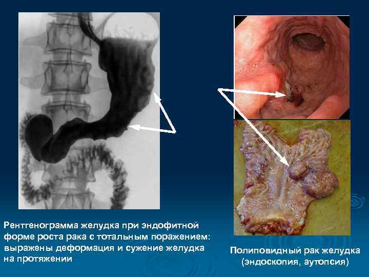 Рентгенограмма желудка при эндофитной форме роста рака с тотальным поражением: выражены деформация и сужение