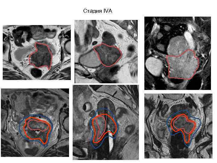 Локальная гипертермия – метод физической радиомодификации ННИИПК им. академика Е. Н. Мешалкина 