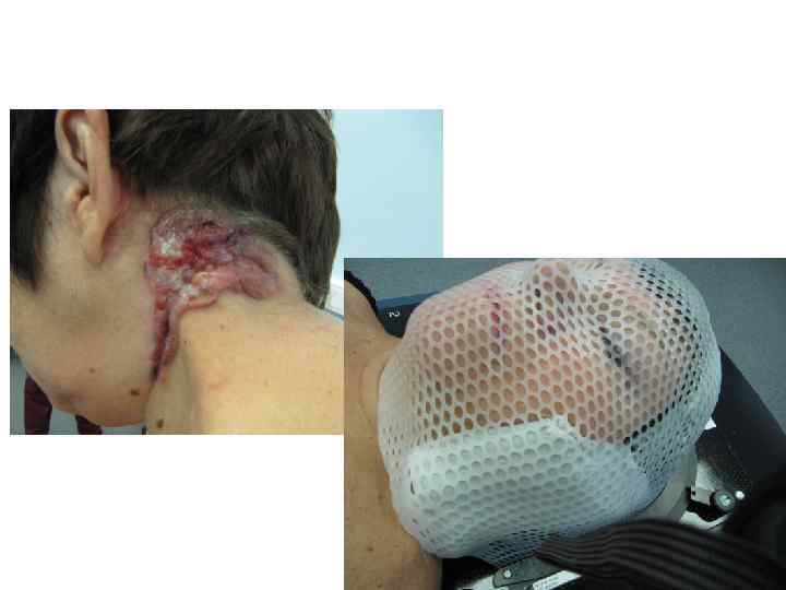 Клинический пример: Базалиома задней поверхности шеи и волосистой части головы T 4 N 0