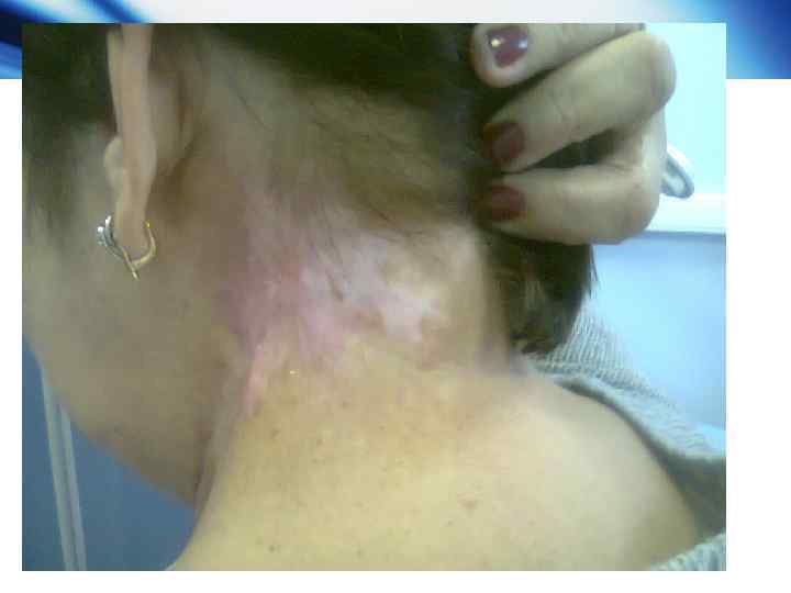  АВС (подвижные мишени) • Преимущества АBC (Active Breathing Coordinator) • Сокращение объёма облученной