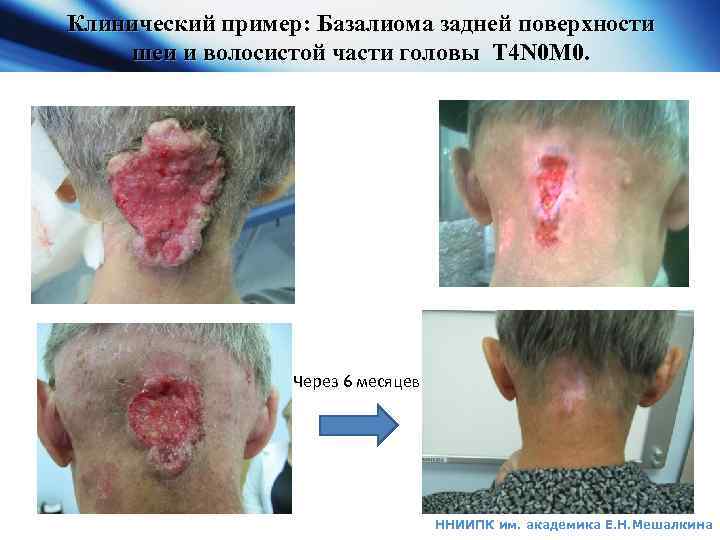 АВС – активный контроль за дыханием ННИИПК им. академика Е. Н. Мешалкина 