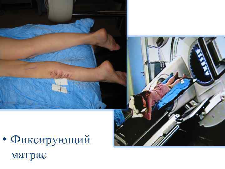  Контурирование мишени и критических структур Оконтуривание объемов облучения и совмещение изображений проводится на