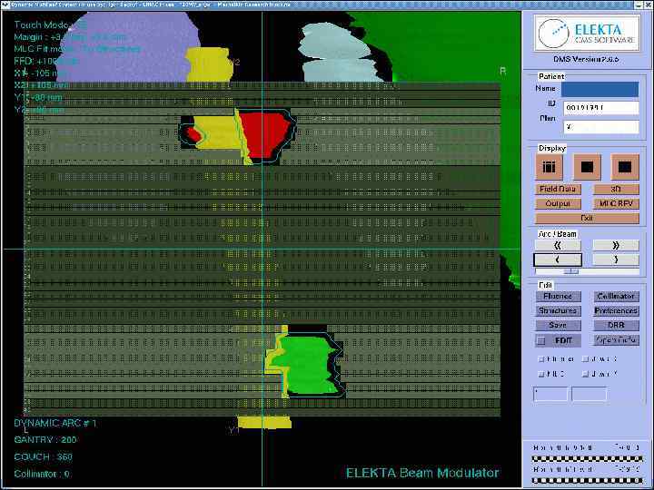  Гипофракционная стереотаксическая лучевая терапия (H-SRT) ННИИПК им. академика Е. Н. Мешалкина 
