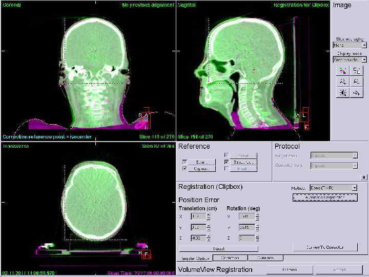  Радиохирургия ЦНС ü Гистологическая структура ü Степень дифференцировки ü Предшествующее лечение ü Локализация