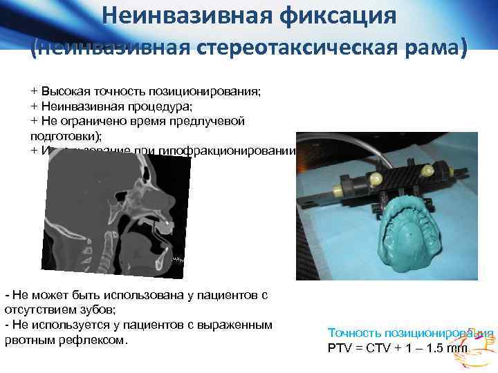  PTV o SRS PTV = GTV = CTV+1 -3 мм o H-SRT PTV