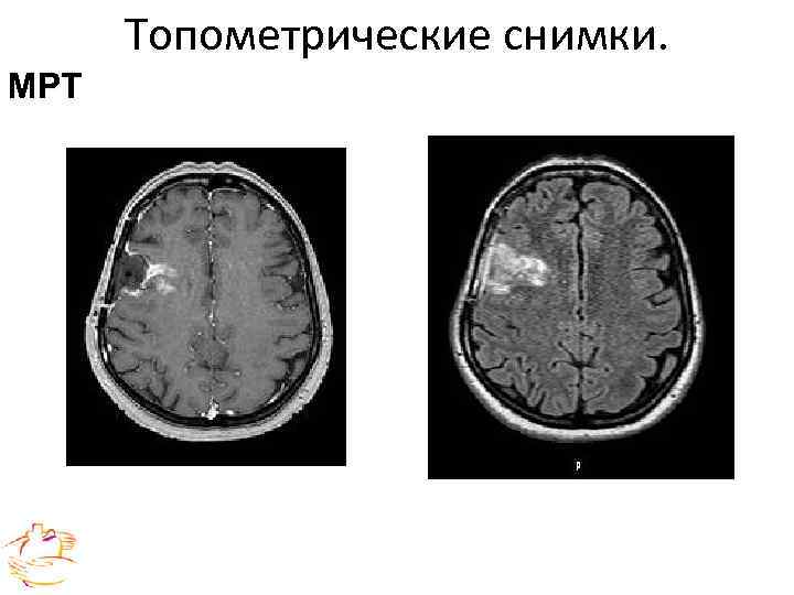  Клинический пример радиохирургическое лечение mts в печени ННИИПК им. академика Е. Н. Мешалкина