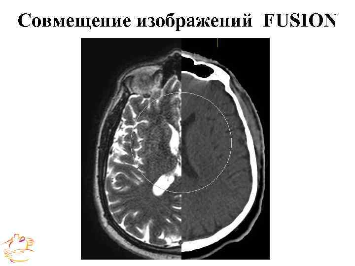  Выводы Использование стереотаксических конформных методик облучения позволяет: • Осуществлять локальный контроль над опухолью