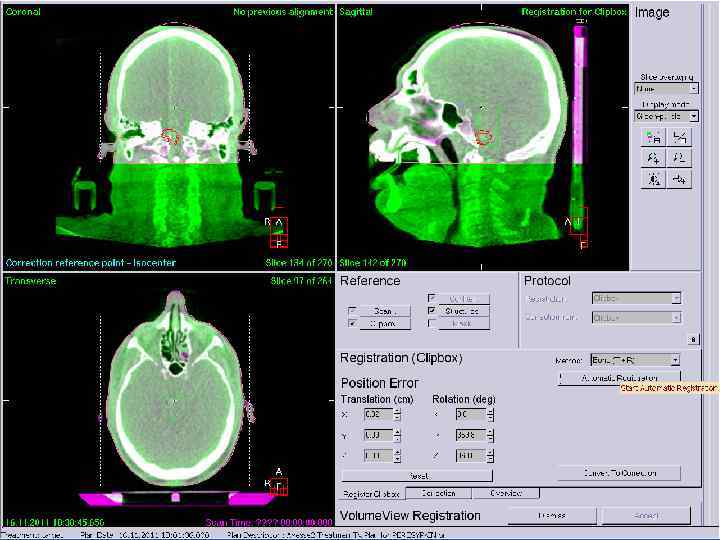 Внутриполостная лучевая терапия ННИИПК им. академика Е. Н. Мешалкина 