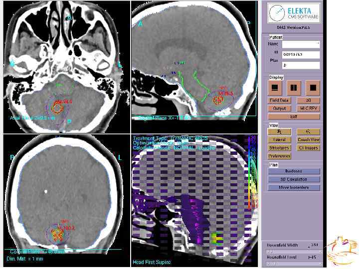  Внутриполостная лучевая терапия • Введение эндостатов • Рентгенологический контроль • Дозиметрическое планирование лучевого