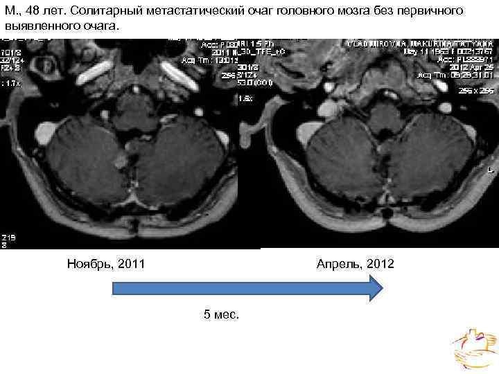 Примеры эндостатов, используемых при лечении рака шейки матки. 