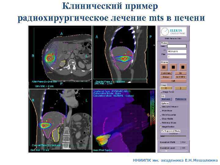 Примеры эндостатов, используемых при внутриполостном лечении 
