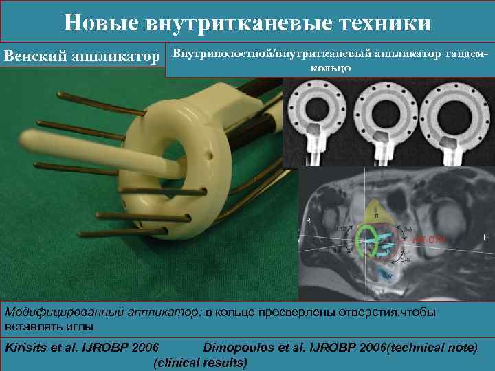 Венский аппликатор Внутриполостной/внутритканевый аппликатор тандем-кольцо Модифицированный аппликатор: в кольце просверлены отверстия, чтобы вставлять иглы