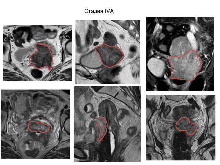 Брахитерапия ННИИПК им. академика Е. Н. Мешалкина 