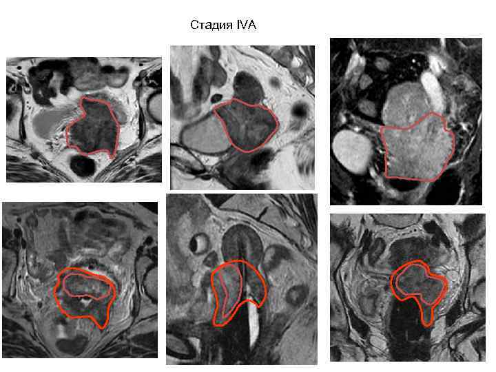 Брахитерапия Показания: • T 1 -T 2. • Локализованная опухоль без прорастания капсулы •