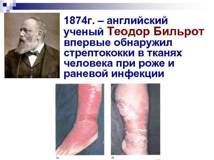 1874 г. – английский ученый Теодор Бильрот впервые обнаружил стрептококки в тканях человека при