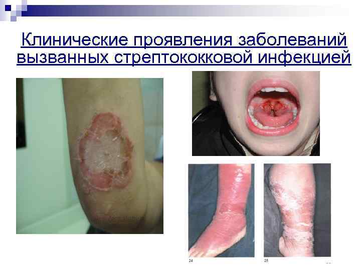 Клинические проявления заболеваний вызванных стрептококковой инфекцией 