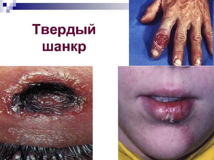 Твердый шанкр 
