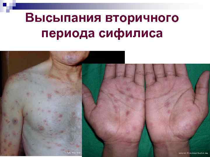 Высыпания вторичного периода сифилиса 