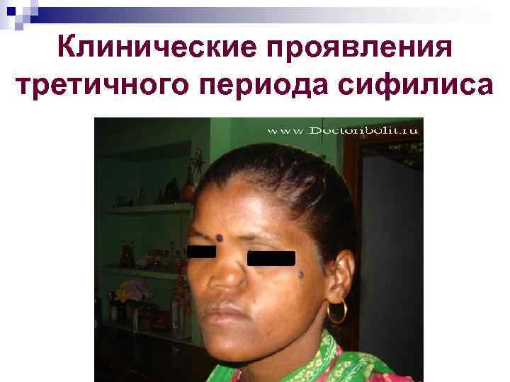Клинические проявления третичного периода сифилиса 