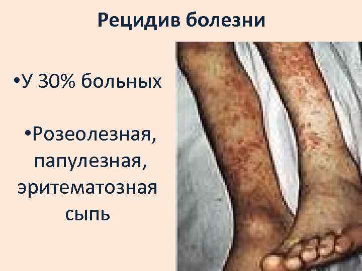 Рецидив болезни • У 30% больных • Розеолезная, папулезная, эритематозная сыпь 