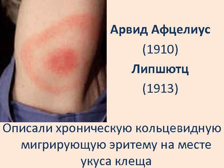 Арвид Афцелиус (1910) Липшютц (1913) Описали хроническую кольцевидную мигрирующую эритему на месте укуса клеща