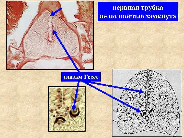 нервная трубка не полностью замкнута глазки Гессе 