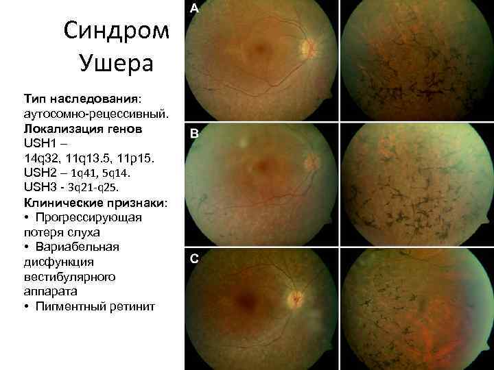 Синдром ушера фото