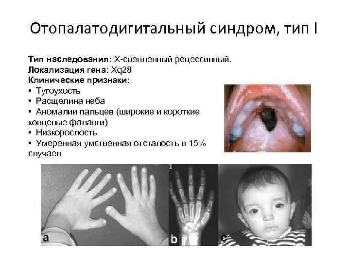 Синдром барде бидля презентация