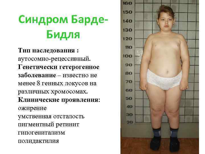Синдром Барде. Бидля Тип наследования : аутосомно-рецессивный. Генетически гетерогенное заболевание – известно не менее