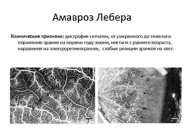 Синдром лебера тип наследования. Наследственная оптическая нейропатия Лебера. Атрофия зрительного нерва Лебера генетика.