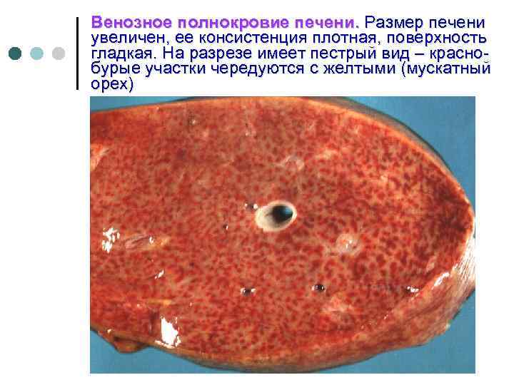 Венозное полнокровие печени. Размер печени увеличен, ее консистенция плотная, поверхность гладкая. На разрезе имеет
