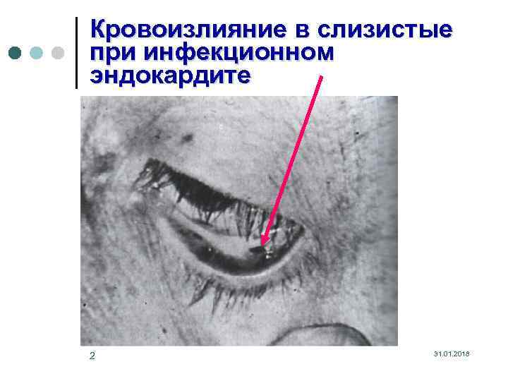 Кровоизлияние в слизистые при инфекционном эндокардите 2 31. 01. 2018 