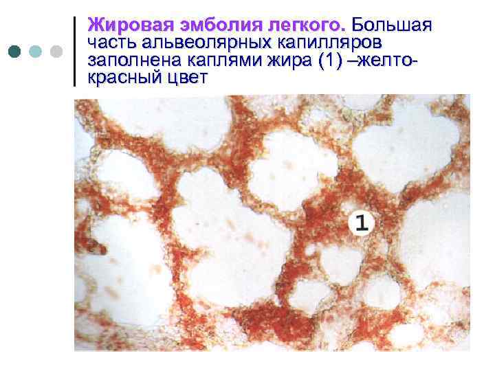 Масляная эмболия фото