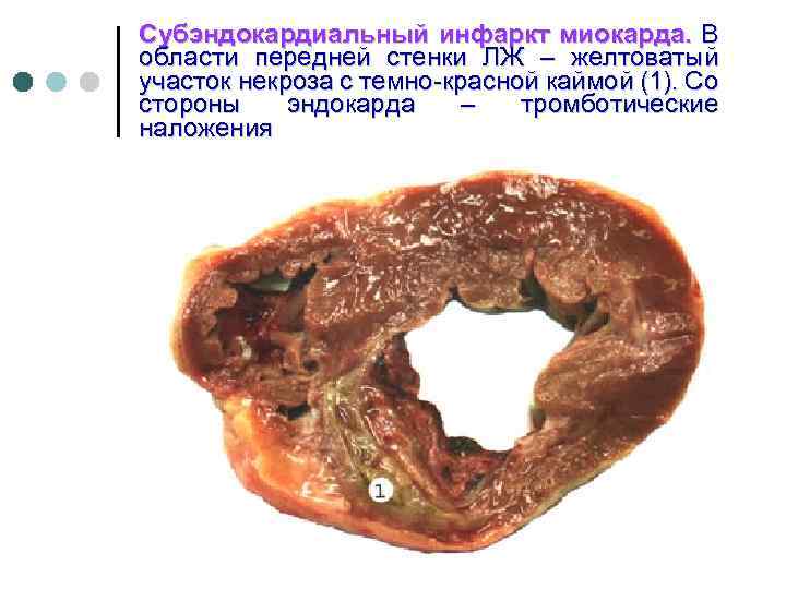 Субэндокардиальная ишемия на экг фото