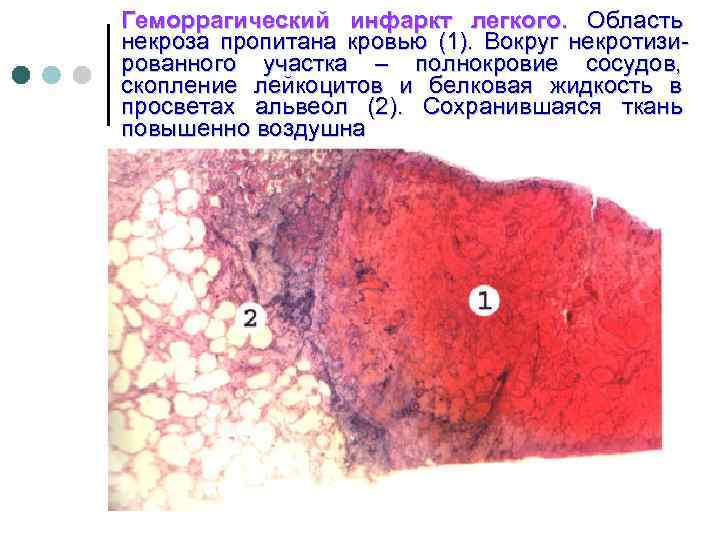 Геморрагический инфаркт легкого. Область некроза пропитана кровью (1). Вокруг некротизированного участка – полнокровие сосудов,