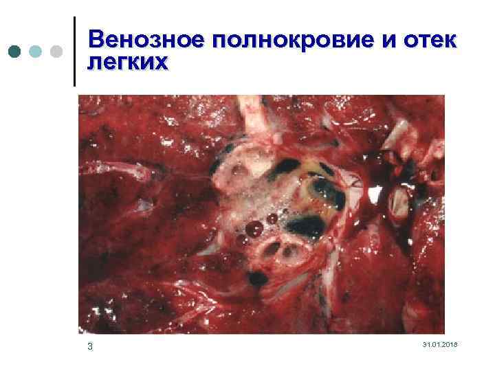 Венозное полнокровие и отек легких 3 31. 01. 2018 